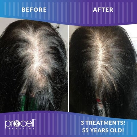 ProCell Micro-channeling Hair Restoration