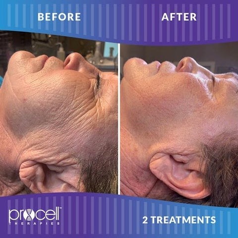 ProCell Micro-channeling Skin Rejuvenation